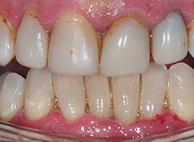 Before Treatment